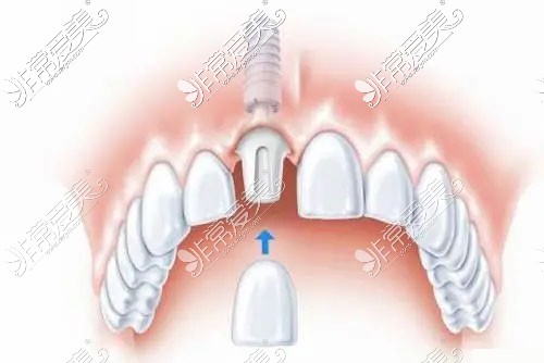 前门牙种植修复示意图