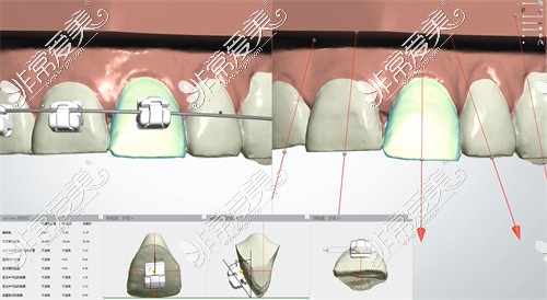 牙齿矫正示意图