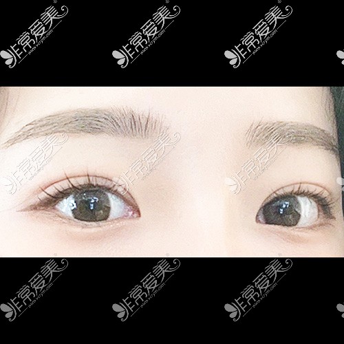 韩国icon整形双眼皮术后图