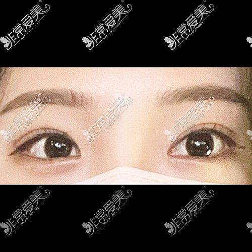 韩国icon整形双眼皮图片