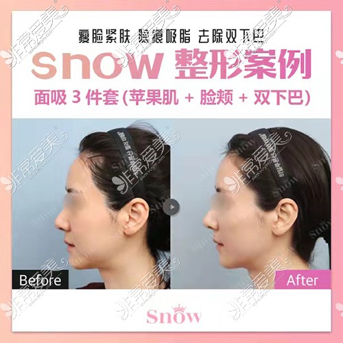 韩国snow整形面部吸脂图片