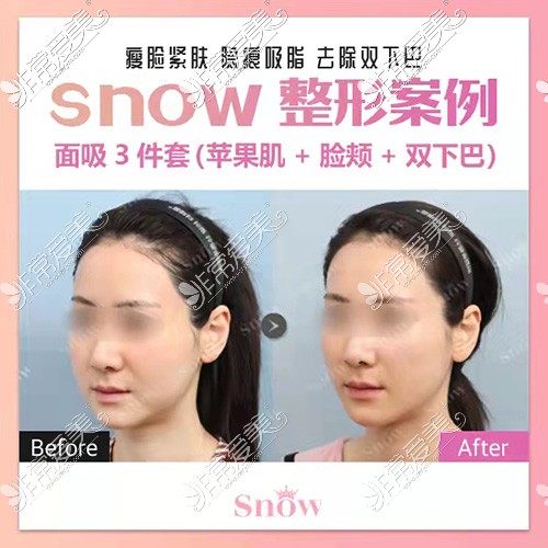 韩国snow整形面部吸脂对比真实