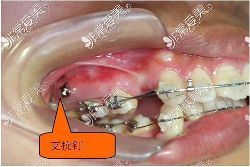 隐形牙套支抗钉图片图片