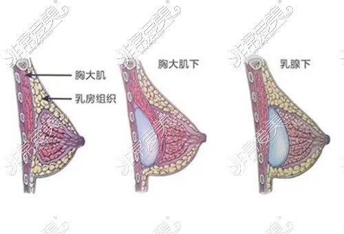 假体隆胸植入的位置