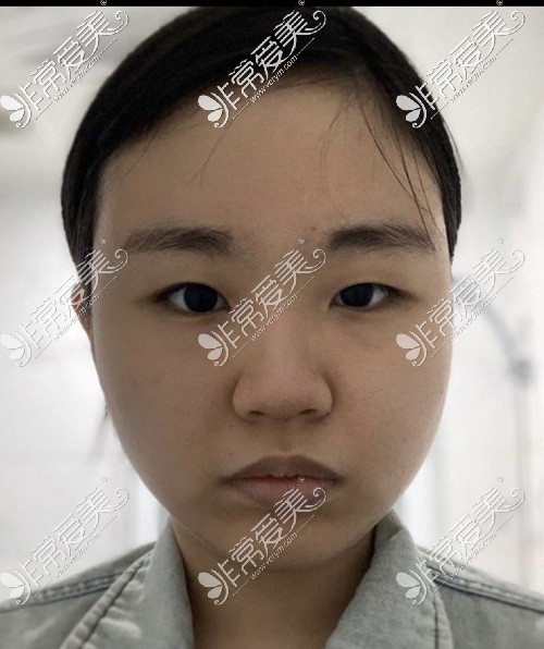 韩国VG百利酷整形外科全切双眼皮+鼻综合术前