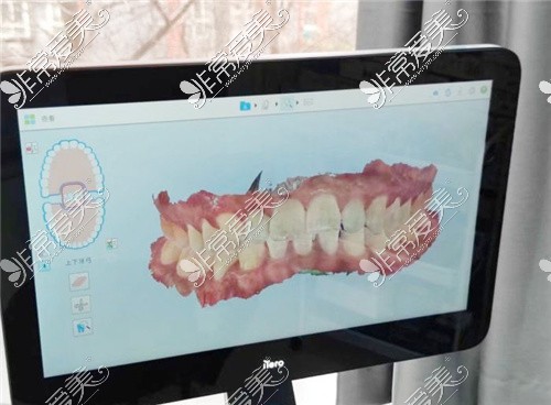 數(shù)字化口腔正畸掃描