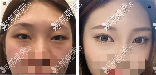 韩国UcanB整形外科埋线双眼皮对比