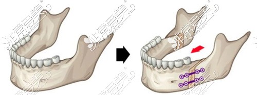 正颌手术骨头如何变化