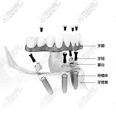 半口種植牙改善治療展示