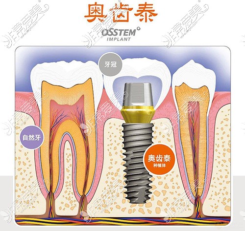 还在问盐城种植牙多少钱一颗?定是你没看这份种牙价格表