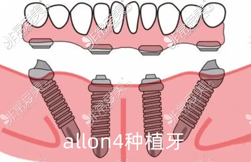 allon4種植牙詳細步驟