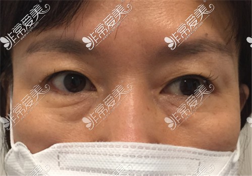 UcanB整形外科外切祛眼袋术前