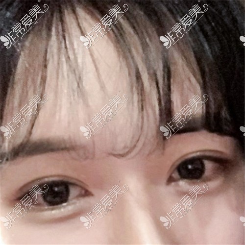 韩国Yellow整形外科眼部整形术后30天图