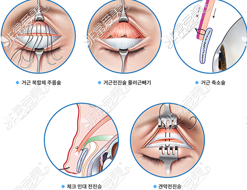 韩国眼部修复十大医生,含修复双眼皮和内眼角修复厉害医生!
