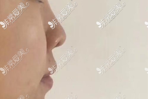 玻尿酸隆鼻的副作用和危害！哈尔滨雅美吴谦院长隆鼻修复