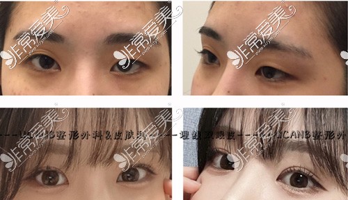 韩国ucanb埋线双眼皮手术前后照片