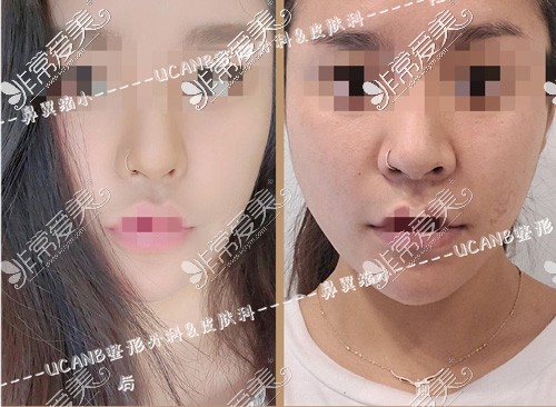 韩国ucanb整形鼻翼缩小手术前后图片
