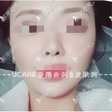 韩国ucanb整形面部填充术后照片