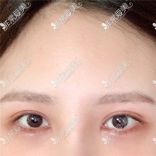 韩国Yellow整形外科埋线双眼皮术后情况