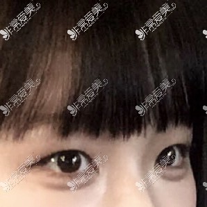 韩国Yellow整形外科埋线双眼皮术前图