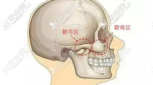 颧骨颧弓改善图照片