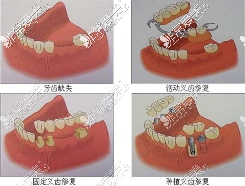 牙齿缺失修复方式示意图