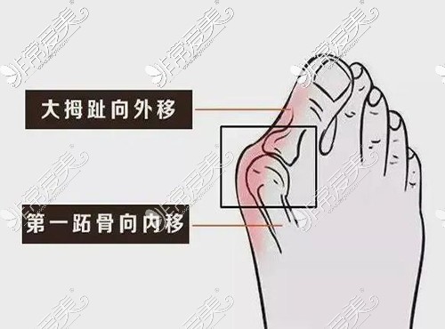 长春大脚骨手术哪家医院好？顺便说一下大脚骨的危害