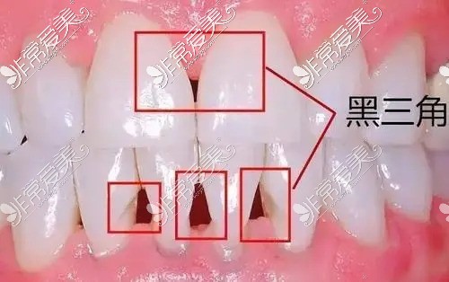 牙龈萎缩导致黑三角
