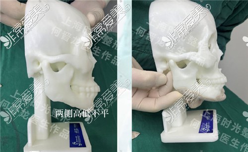 3d打印人工骨修復(fù)下頜角模型圖