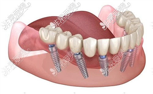 all-on-4/6种植牙示意图