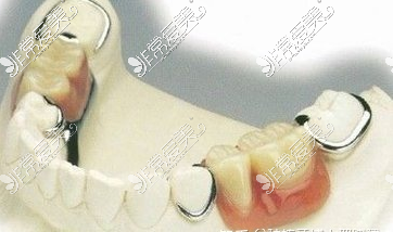 活动假牙修复