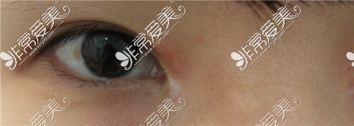 韩国鸣玉轩韩医院内眼角疤痕修复术前图