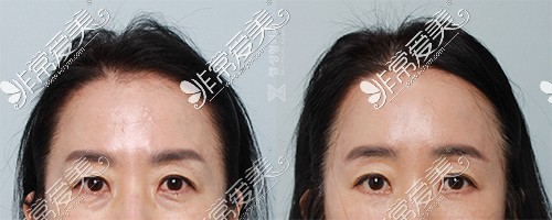韩国ZELL整形外科内视镜额头提升