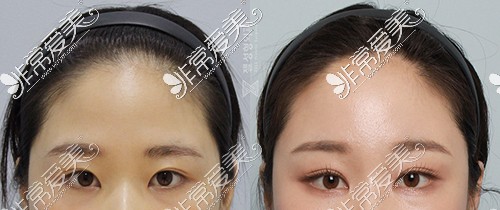 韩国ZELL整形外科额头提升+双眼皮修复