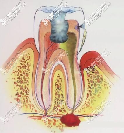 牙髓炎卡通图展示照片