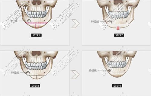 下巴截骨前移手术过程