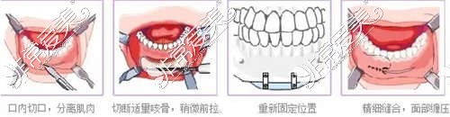 下巴截骨前移手术切口