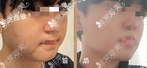 韩国UcanB颊脂垫瘦脸了解一下(图)