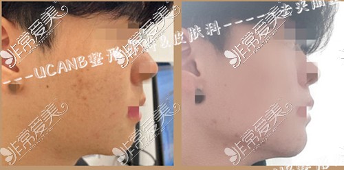 韩国UcanB整形外科男生去颊脂垫对比照片