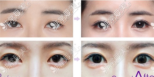 韩国高兰得整容外科眼修复对比