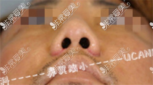 韩国UcanB整形外科做鼻翼缩小手术术后