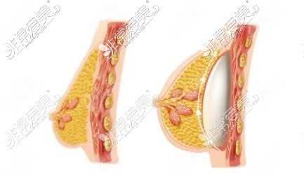 乳房下垂矫正方法图片