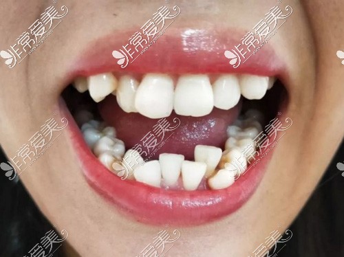 牙列拥挤牙齿照片