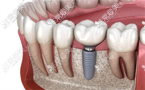 种植牙示意图