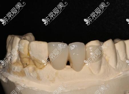 马里兰桥修复义齿照片展示图