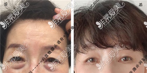 韩国UcanB整形外科做内窥镜额头提升+下眼睑手术前后图