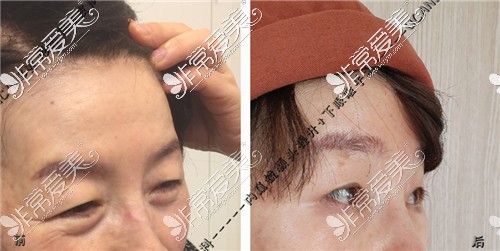 韩国UcanB整形外科做内窥镜额头提升+下眼睑手术对比图