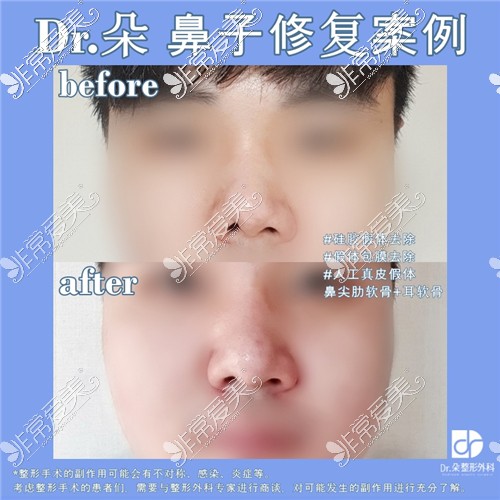 韩国dr.朵整形医院鼻修复前后