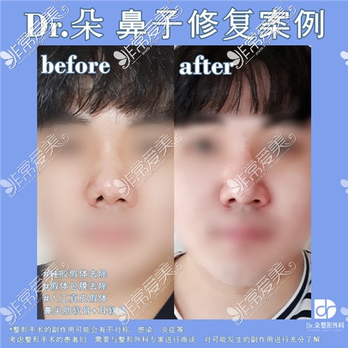 韩国dr.朵整形医院鼻修复对比