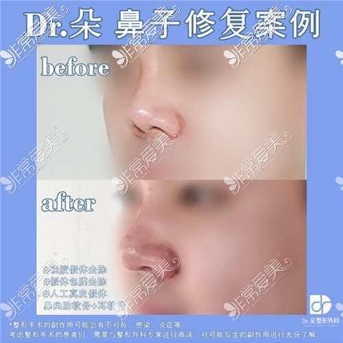 韩国dr.朵整形医院鼻修复前后图